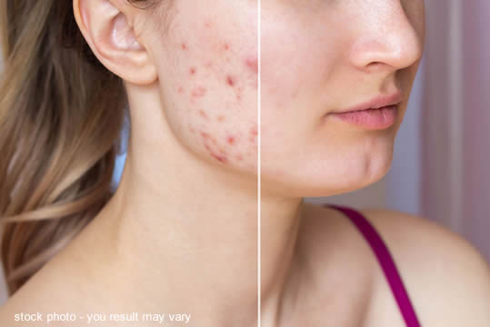 Female with severe acne before and after