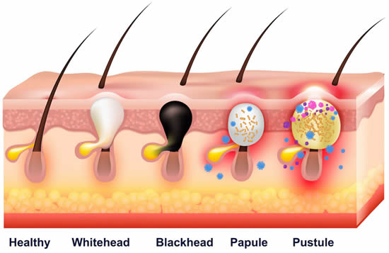 Different types of acne